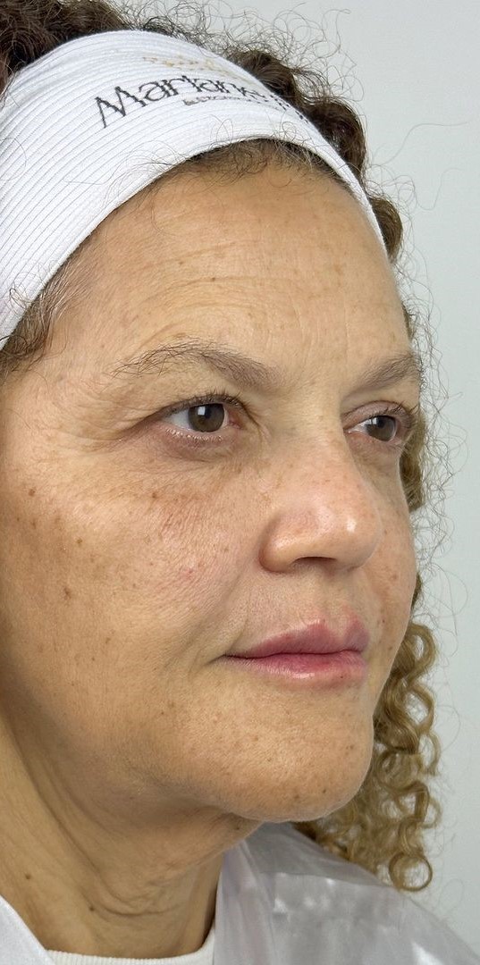 Caso 124 - Rejuvenescimento com renovação da pele fotoenvelhecida