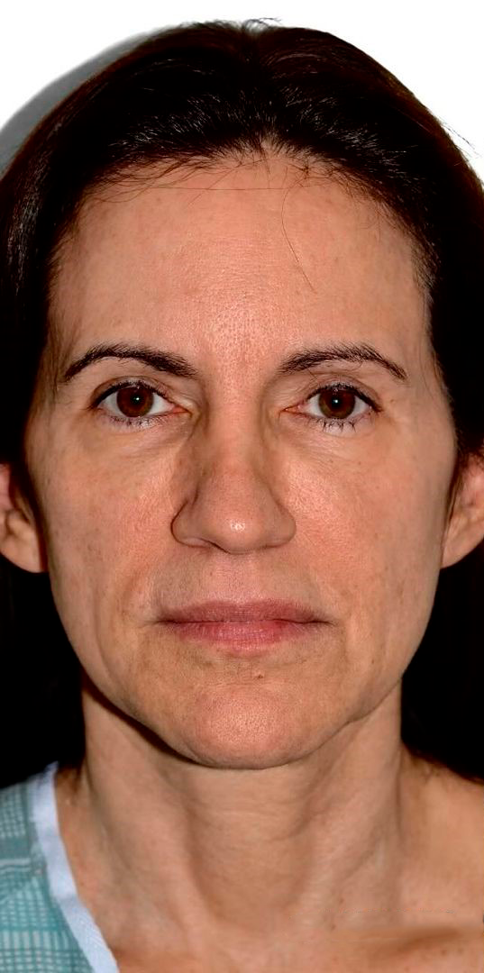 Antes - Rejuvenescimento - Est&eacute;tica Batel Curitiba