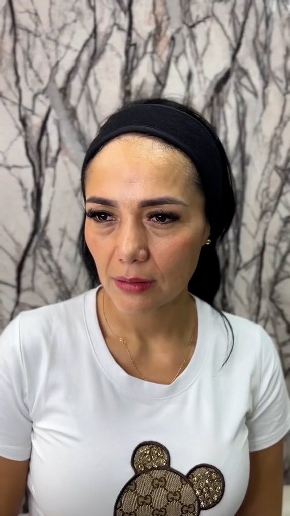 Antes - Rejuvenescimento caso 142