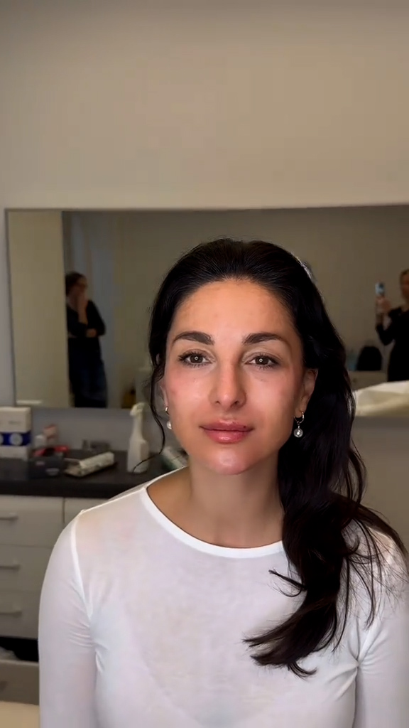 Caso 157 - Rejuvenescimento facial completo com uniformização da pele