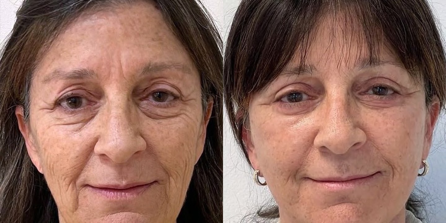 Antes e depois rejuvenescimento caso 01