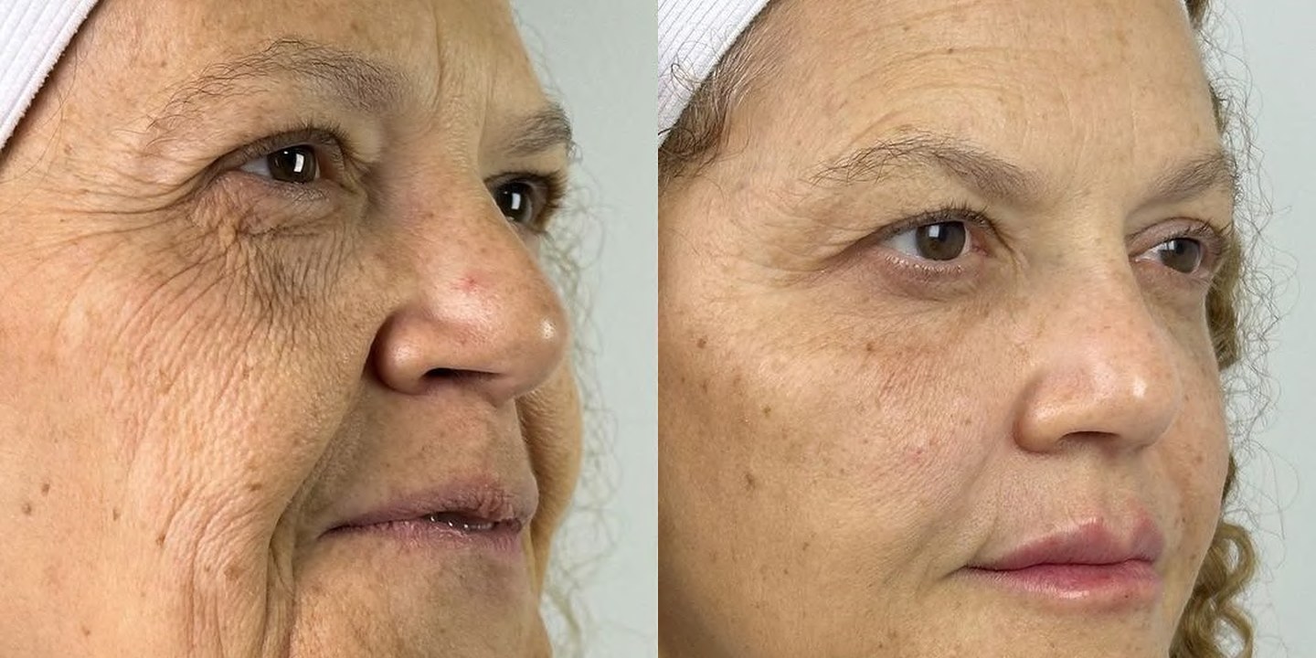 Antes e depois rejuvenescimento caso 10