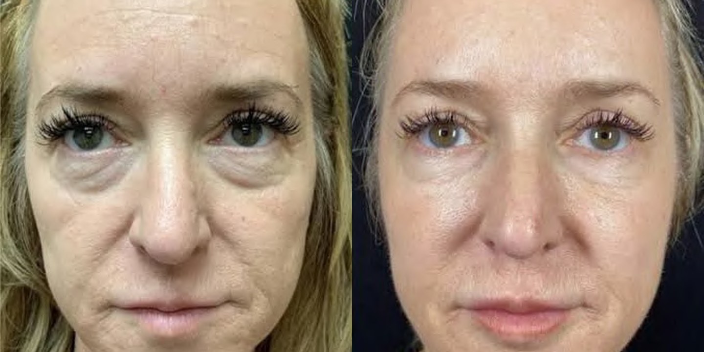 Antes e depois rejuvenescimento caso 11