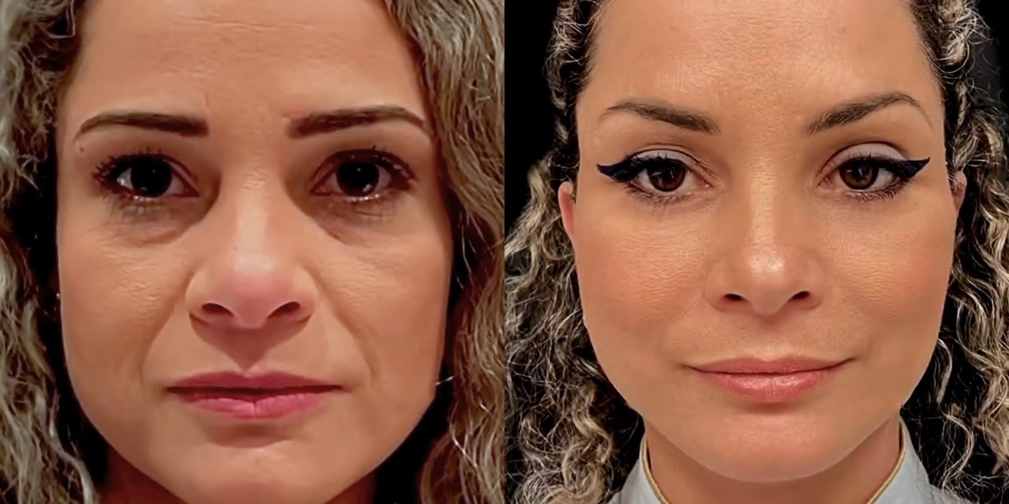Antes e depois rejuvenescimento caso 12