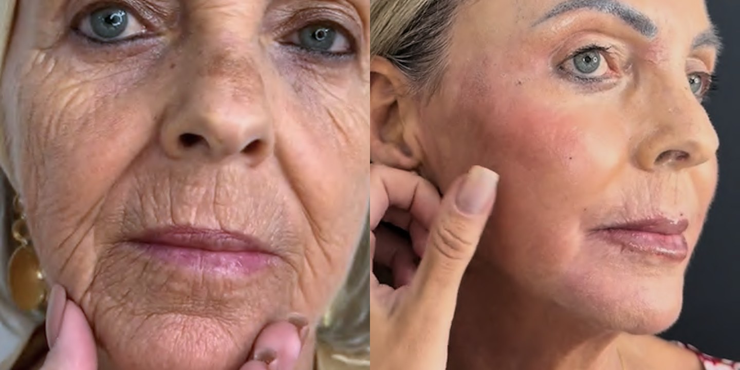 Antes e depois rejuvenescimento caso 13