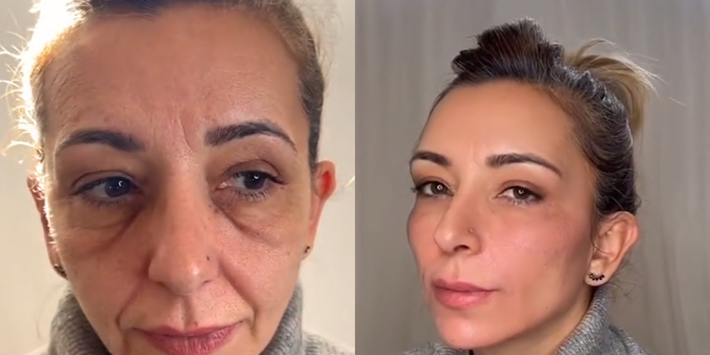 Antes e depois rejuvenescimento caso 14