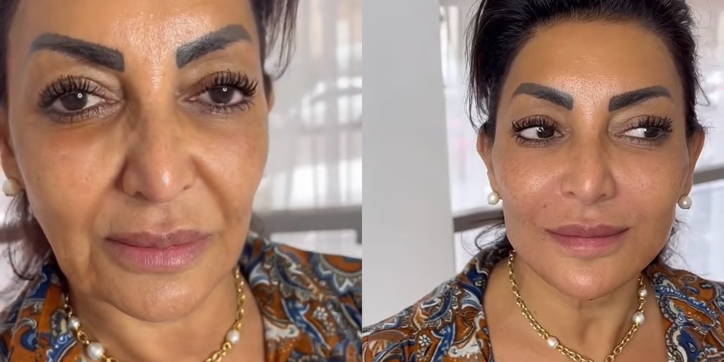 Antes e depois rejuvenescimento caso 15