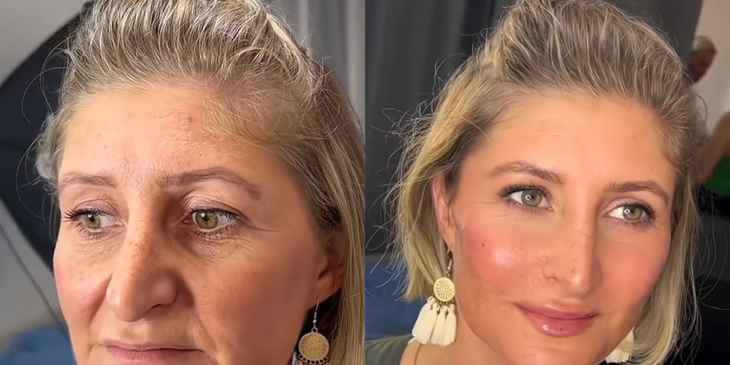 Antes e depois rejuvenescimento caso 16