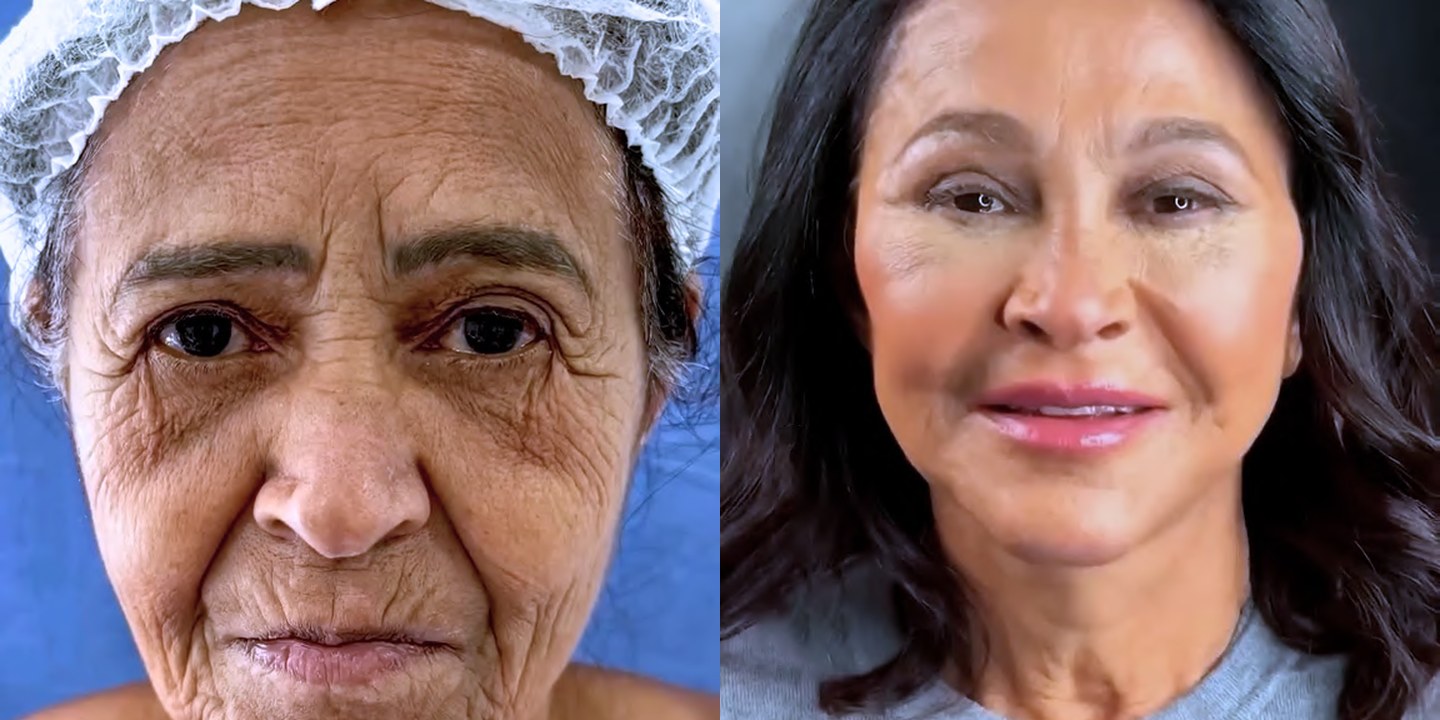 Antes e depois rejuvenescimento caso 17