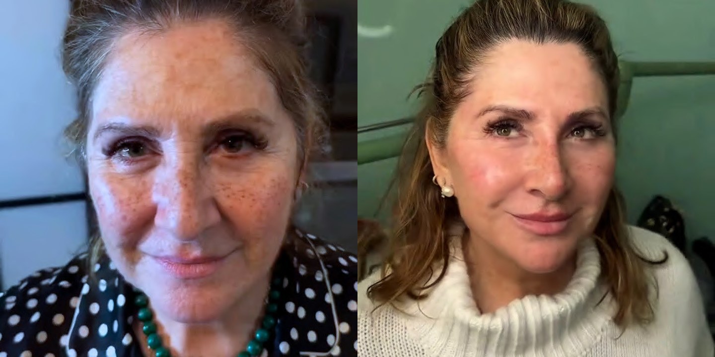 Antes e depois rejuvenescimento caso 18