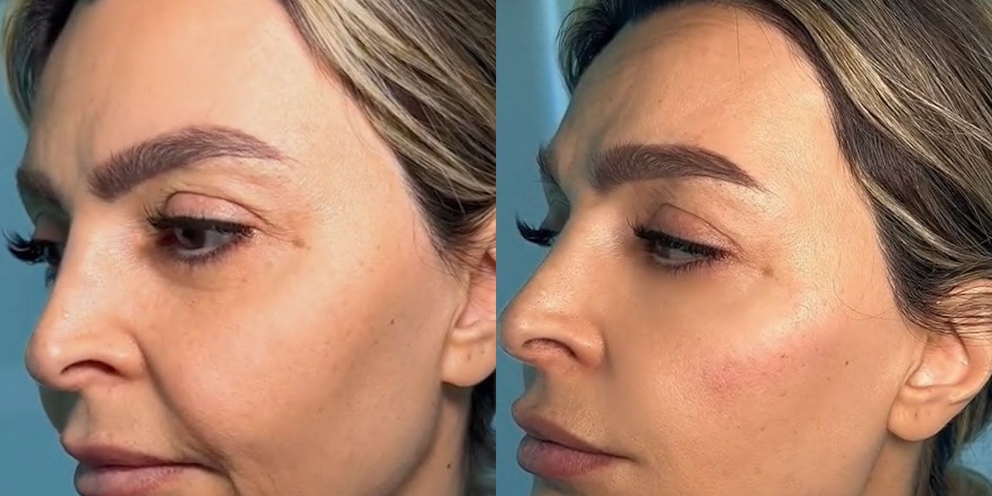 Antes e depois rejuvenescimento caso 19
