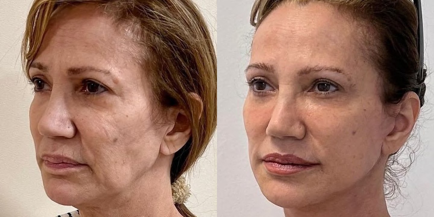 Antes e depois rejuvenescimento caso 02