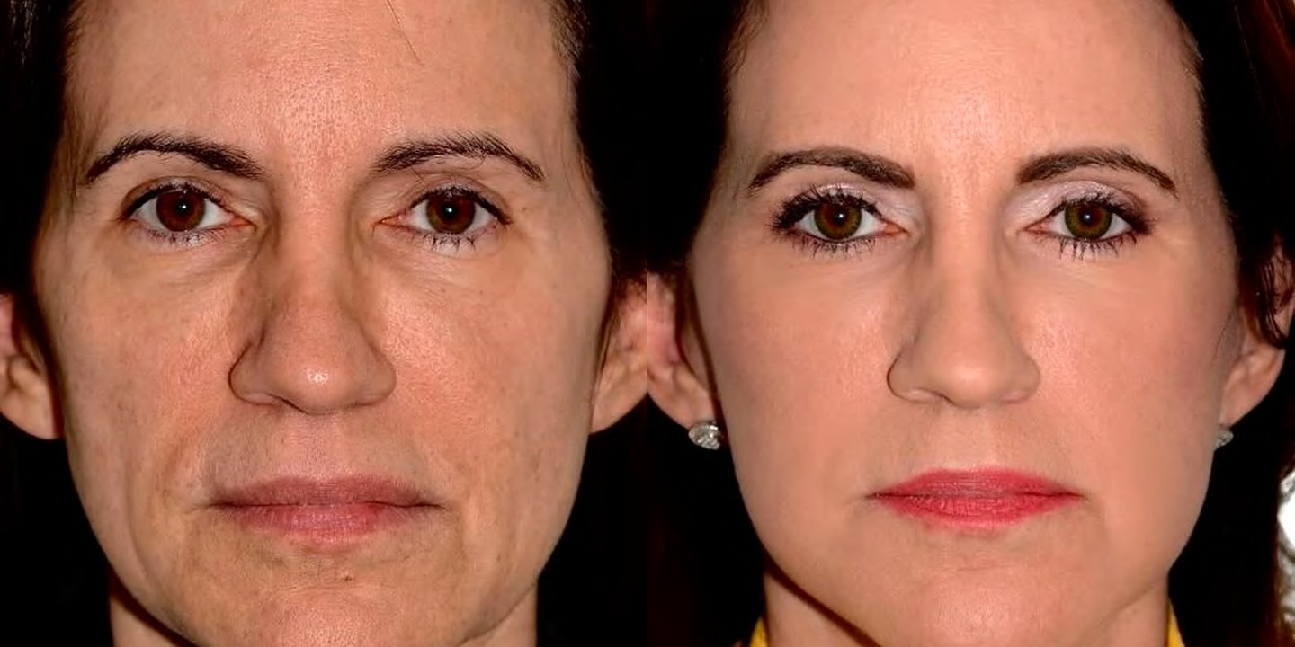 Antes e depois rejuvenescimento caso 20