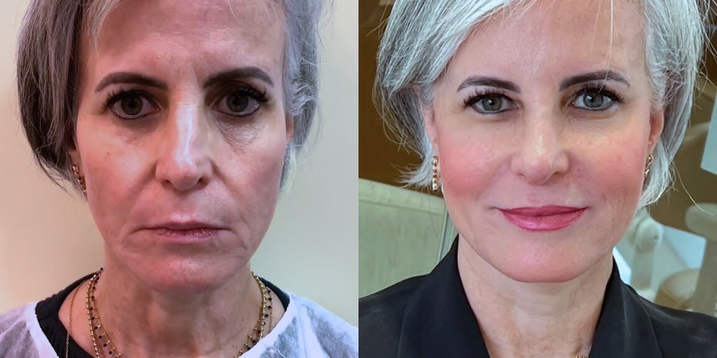 Antes e depois rejuvenescimento caso 21