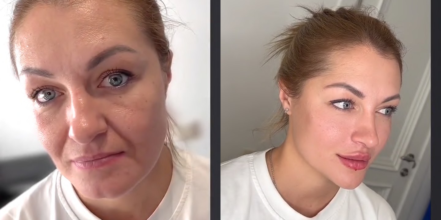 Antes e depois rejuvenescimento caso 22