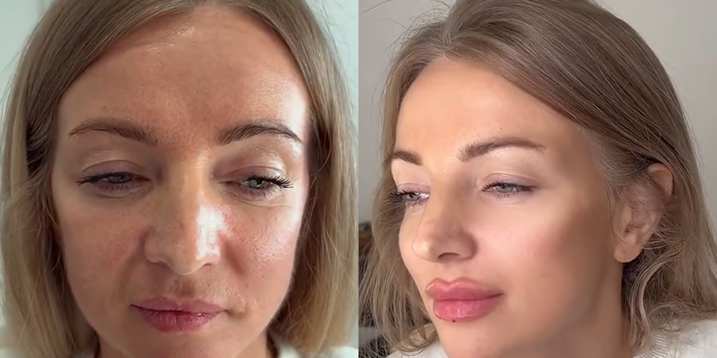 Antes e depois rejuvenescimento caso 23