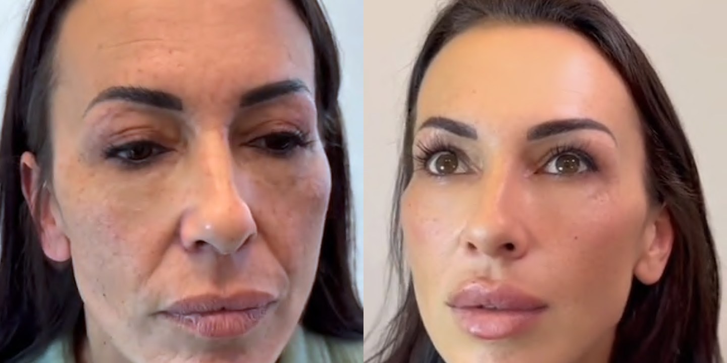 Antes e depois rejuvenescimento caso 24