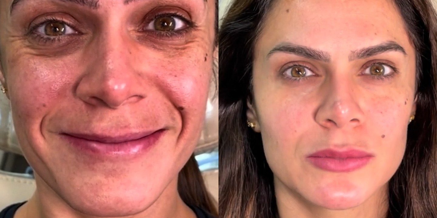 Antes e depois rejuvenescimento caso 25