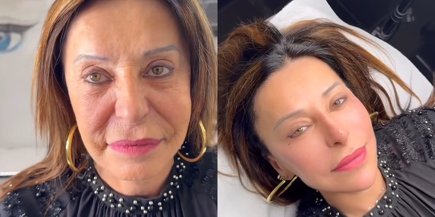 Antes e depois rejuvenescimento caso 26