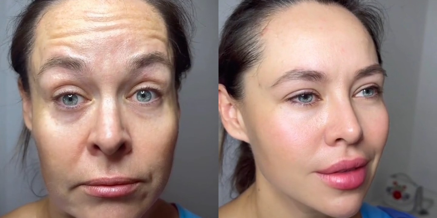 Antes e depois rejuvenescimento caso 27