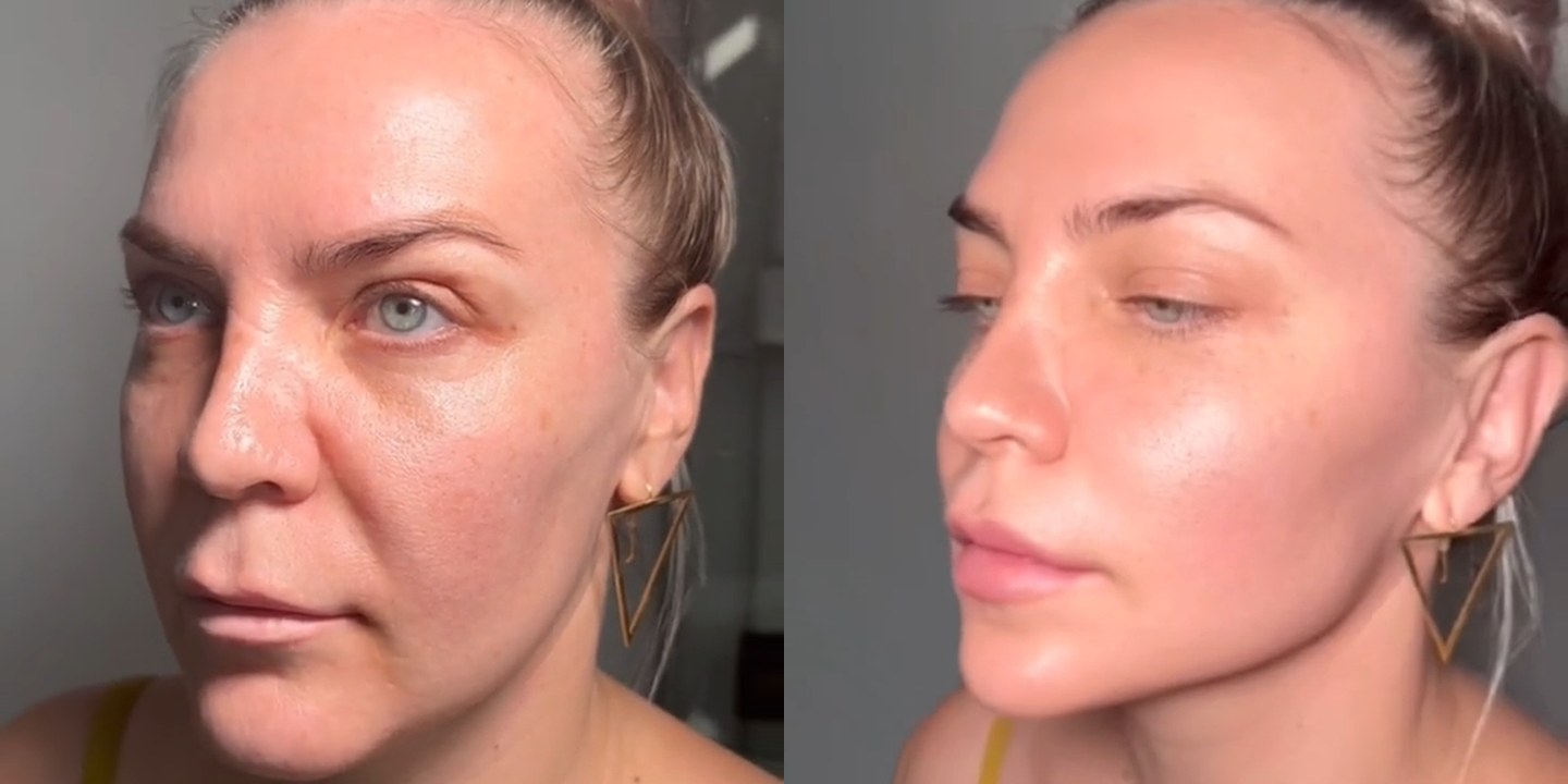 Antes e depois rejuvenescimento caso 28