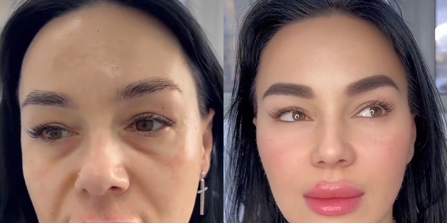 Antes e depois rejuvenescimento caso 29