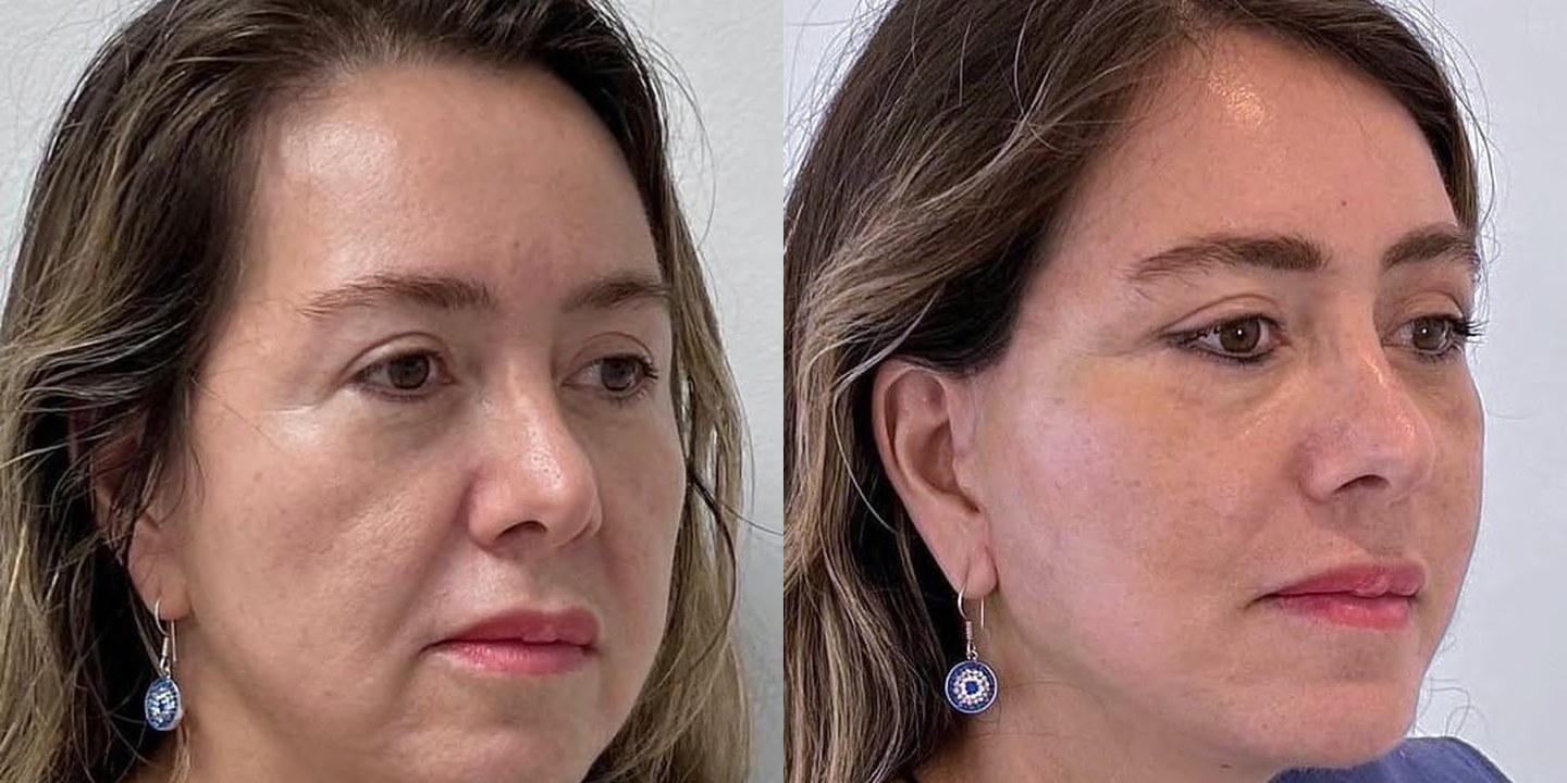 Antes e depois rejuvenescimento caso 03