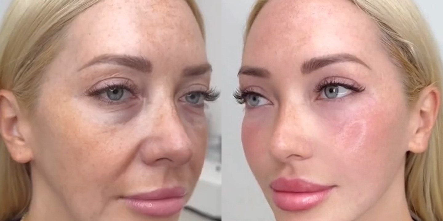 Antes e depois rejuvenescimento caso 30