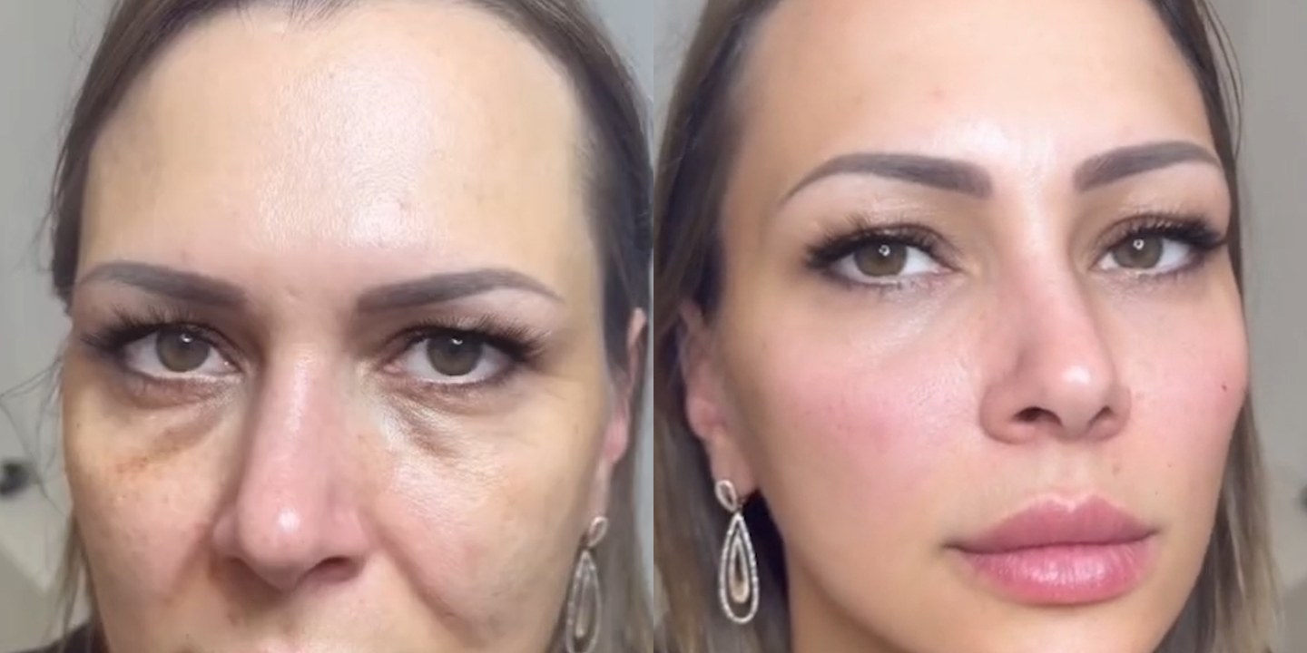 Antes e depois rejuvenescimento caso 31