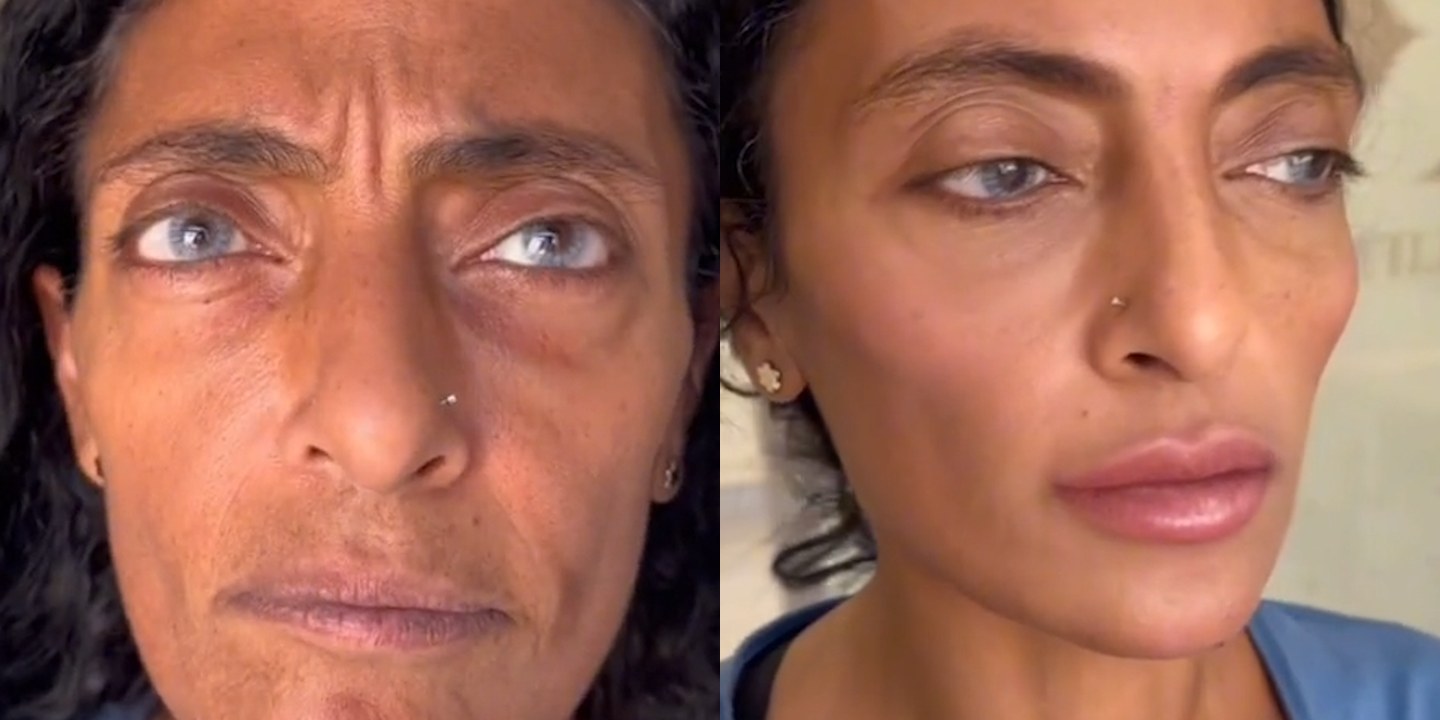 Antes e depois rejuvenescimento caso 32