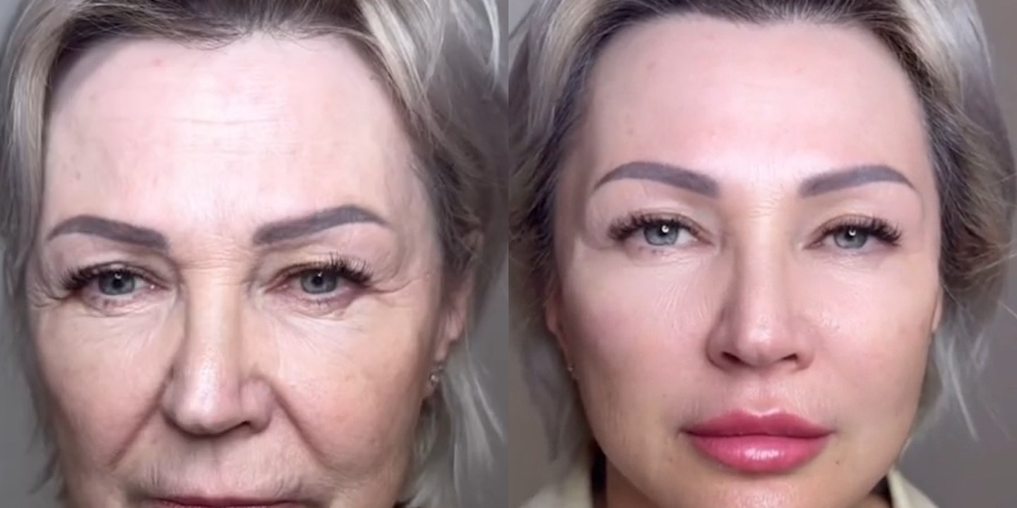 Antes e depois rejuvenescimento caso 33