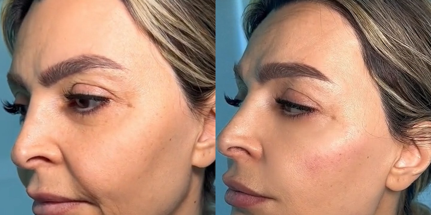 Antes e depois rejuvenescimento caso 34