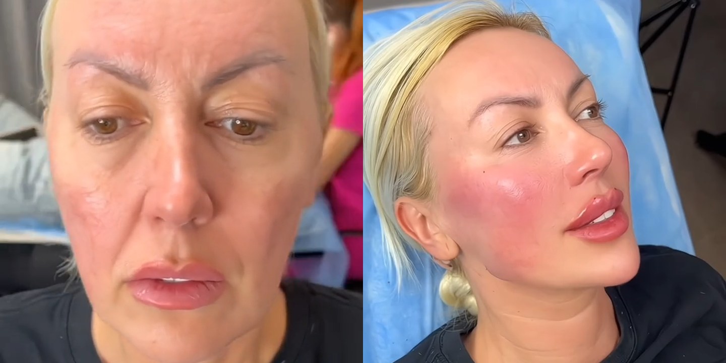 Antes e depois rejuvenescimento caso 35