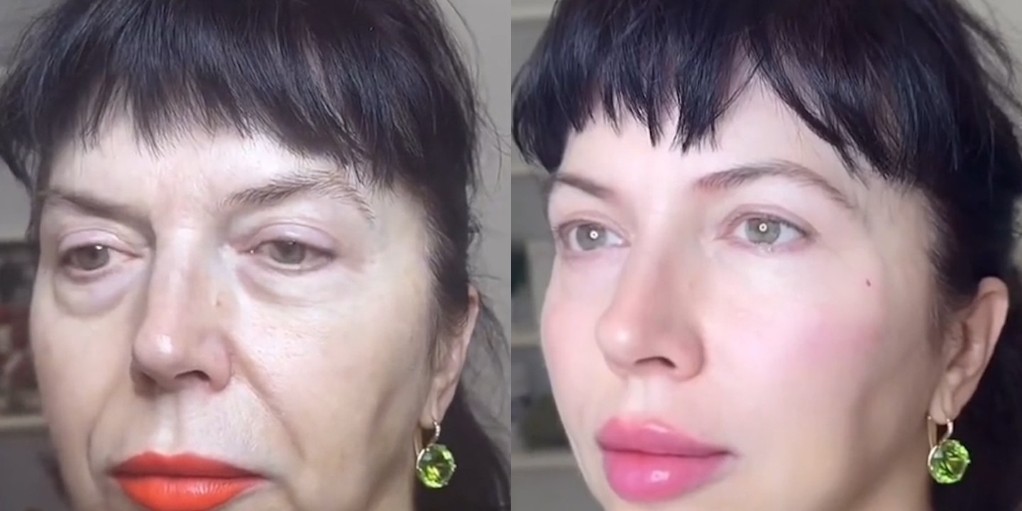 Antes e depois rejuvenescimento caso 36