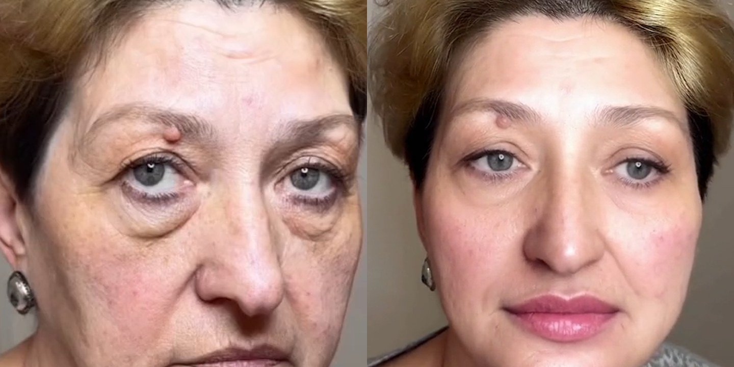 Antes e depois rejuvenescimento caso 37