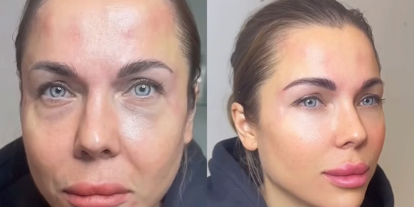 Antes e depois rejuvenescimento caso 38