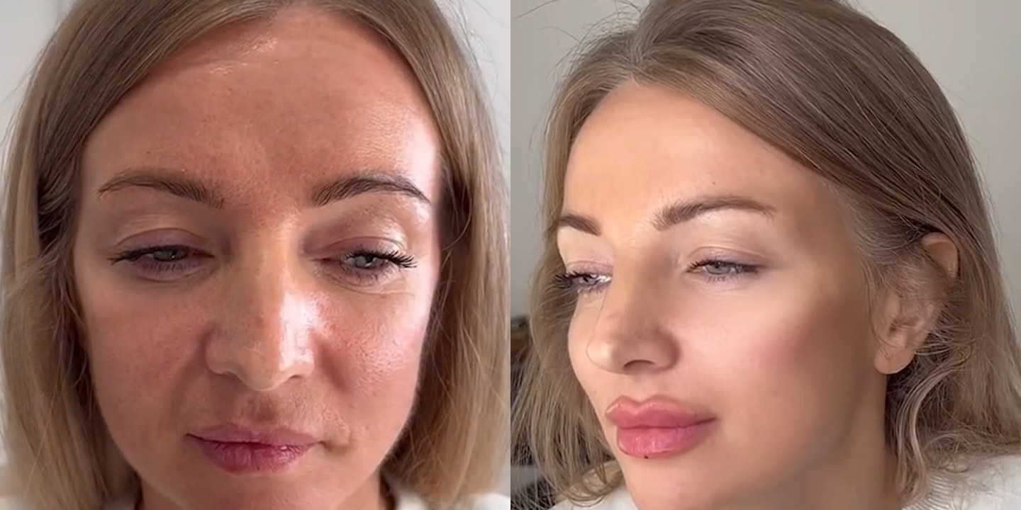 Antes e depois rejuvenescimento caso 39
