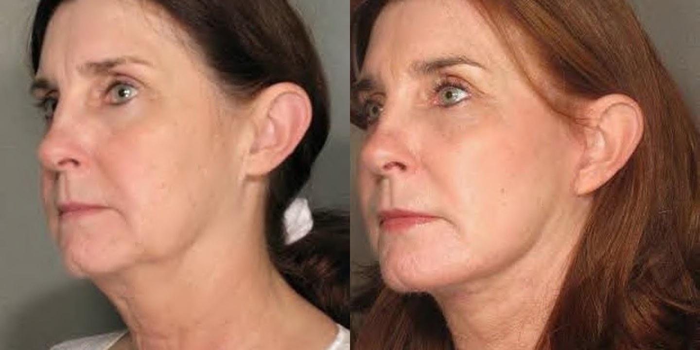 Antes e depois rejuvenescimento caso 04