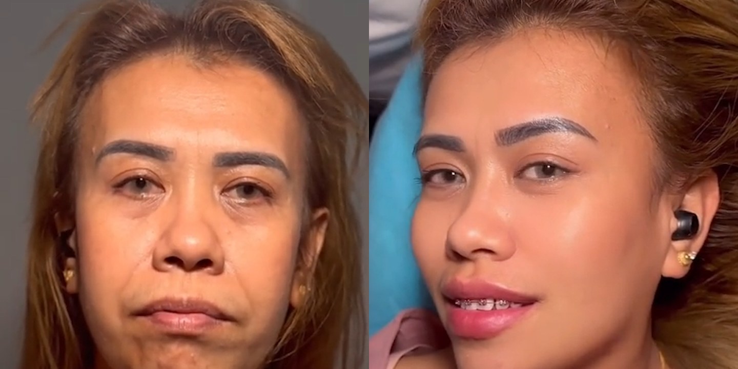 Antes e depois rejuvenescimento caso 40