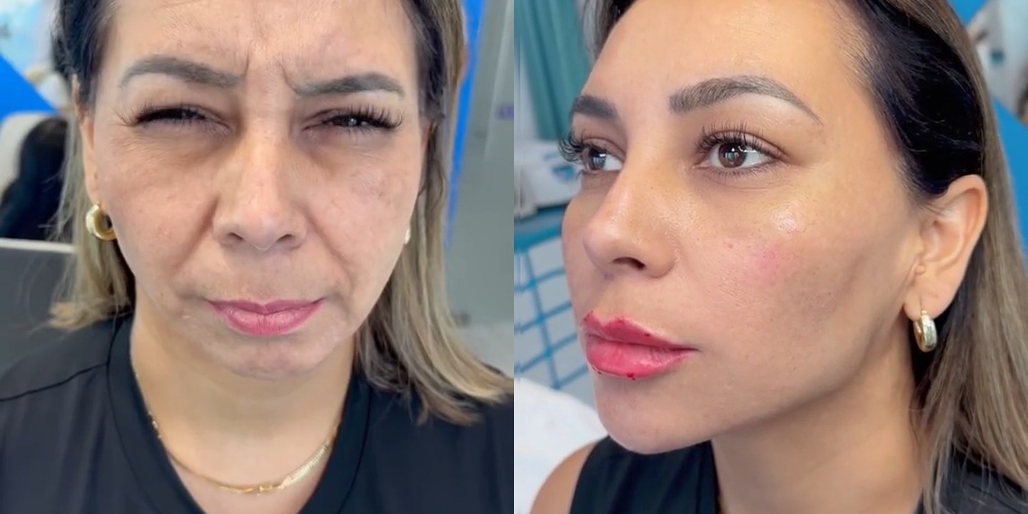 Antes e depois rejuvenescimento caso 42