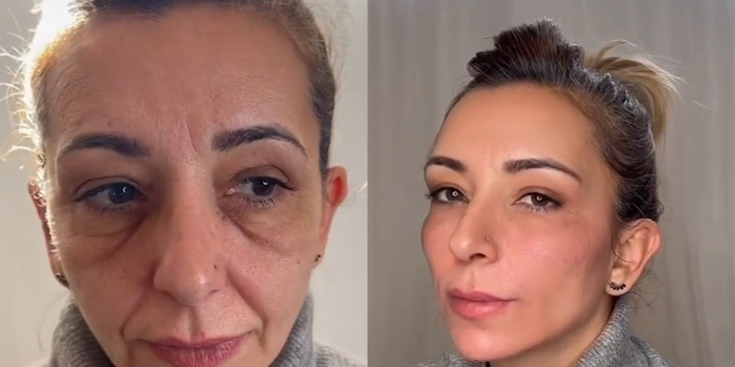 Antes e depois rejuvenescimento caso 43