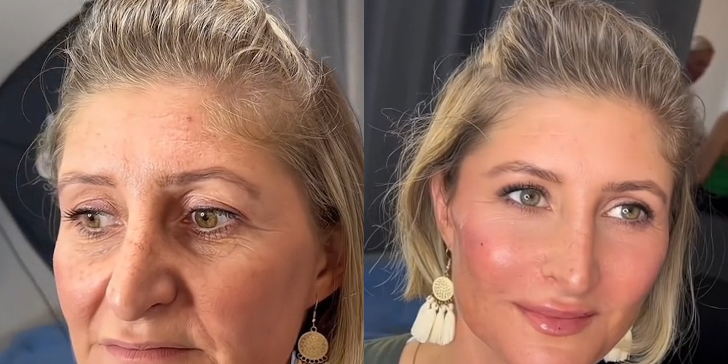 Antes e depois rejuvenescimento caso 44