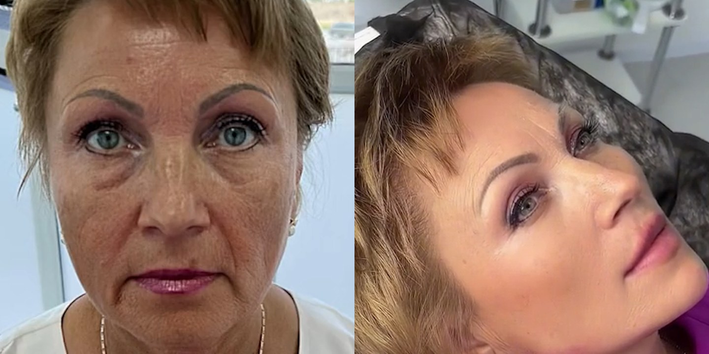 Antes e depois rejuvenescimento caso 45