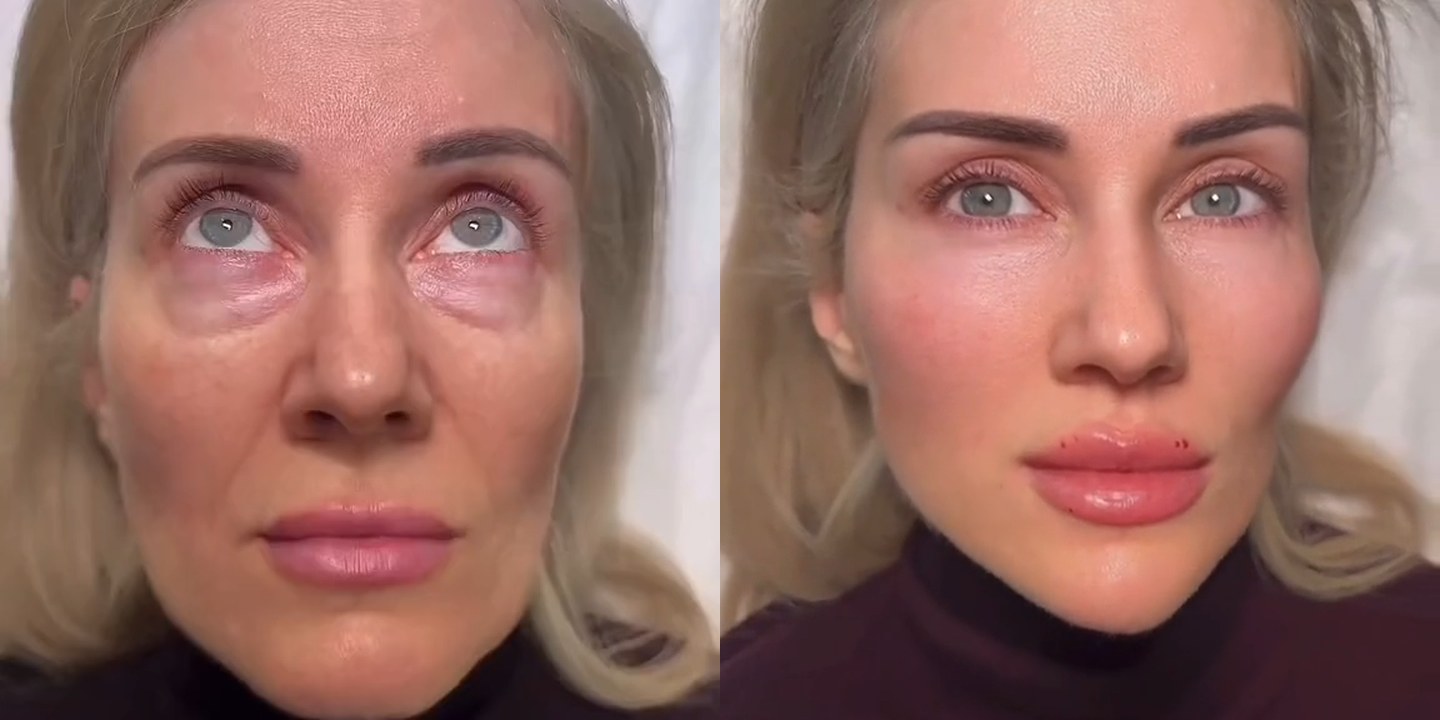 Antes e depois rejuvenescimento caso 46