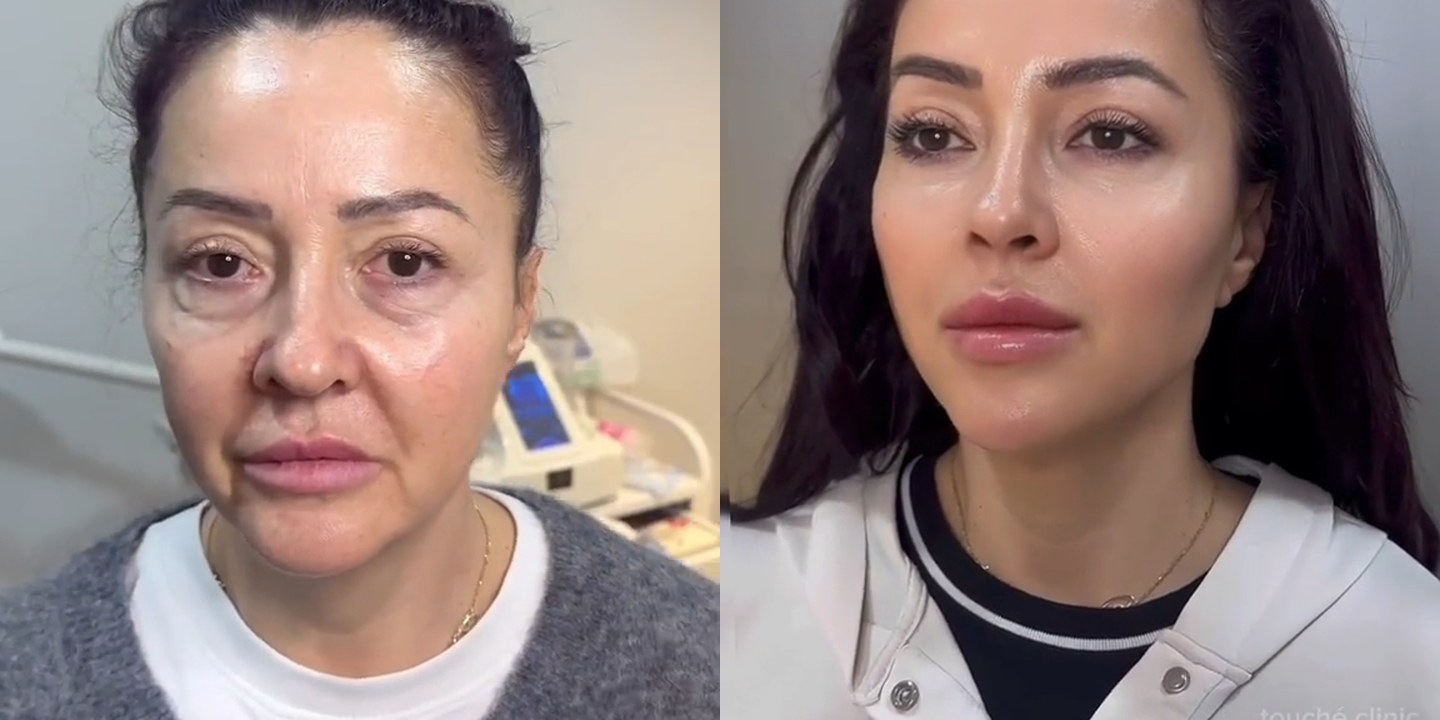 Antes e depois rejuvenescimento caso 47