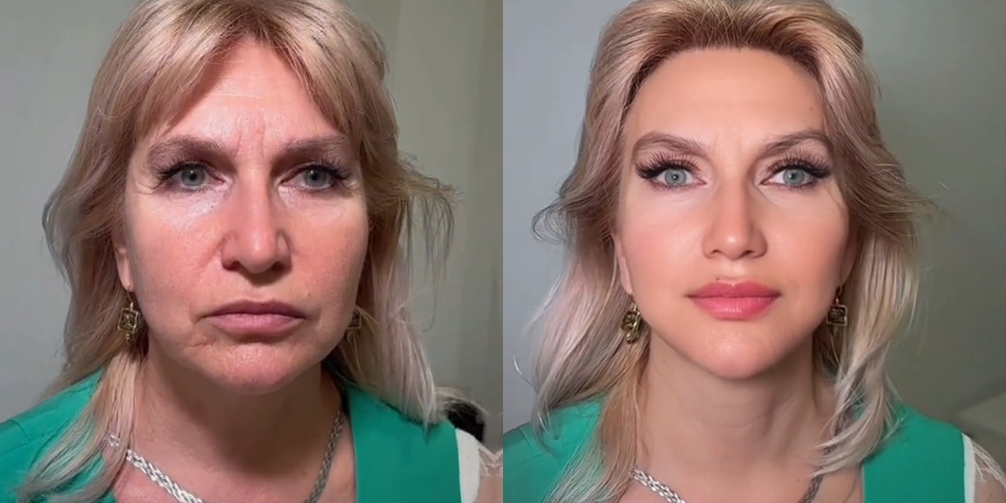 Antes e depois rejuvenescimento caso 48