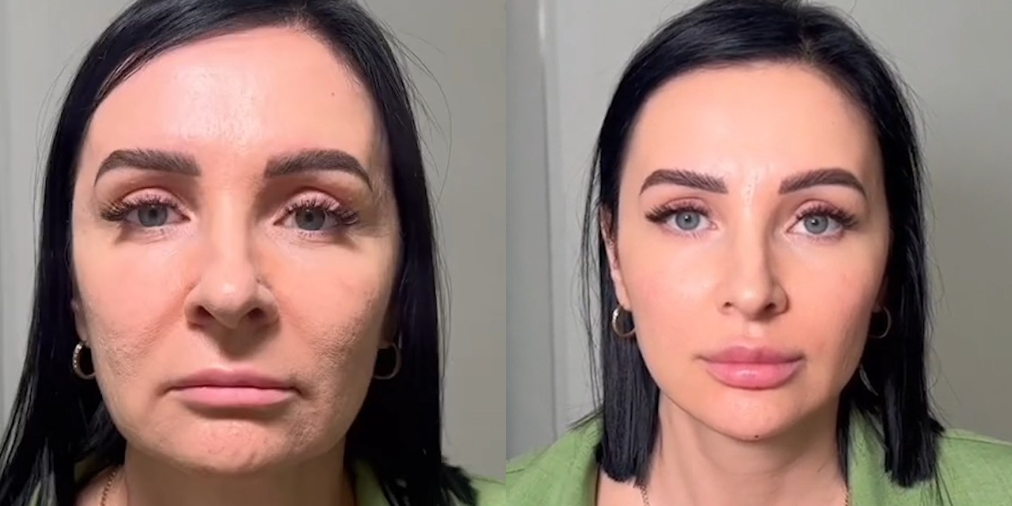 Antes e depois rejuvenescimento caso 49