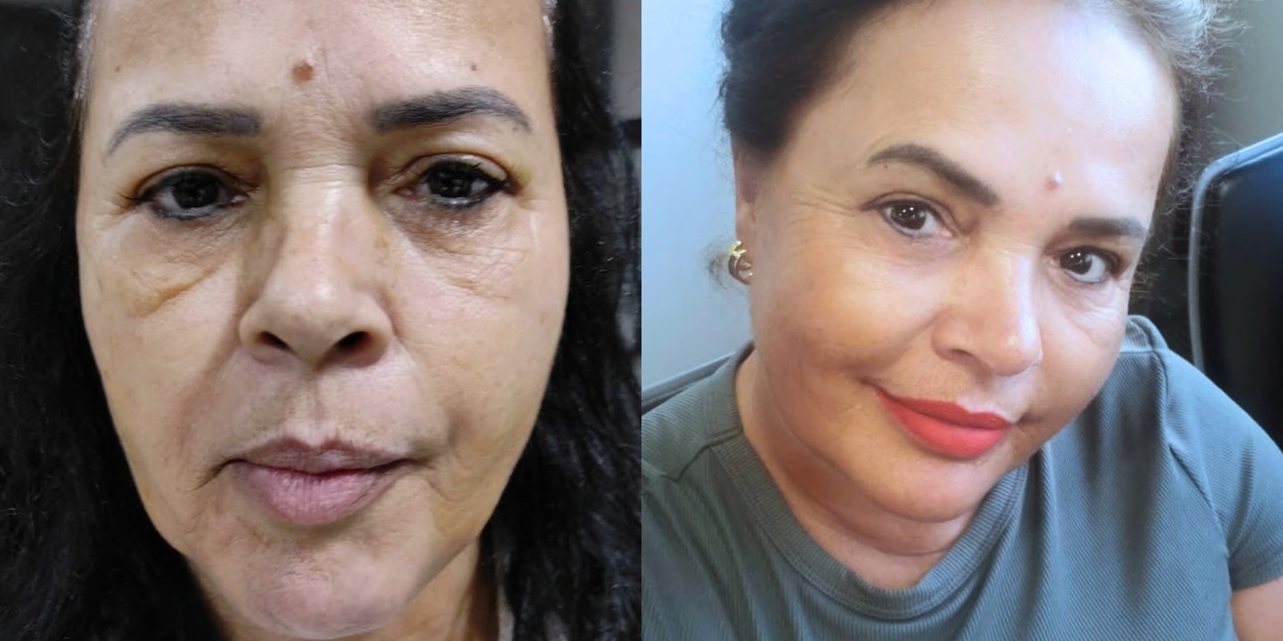 Antes e depois rejuvenescimento caso 05