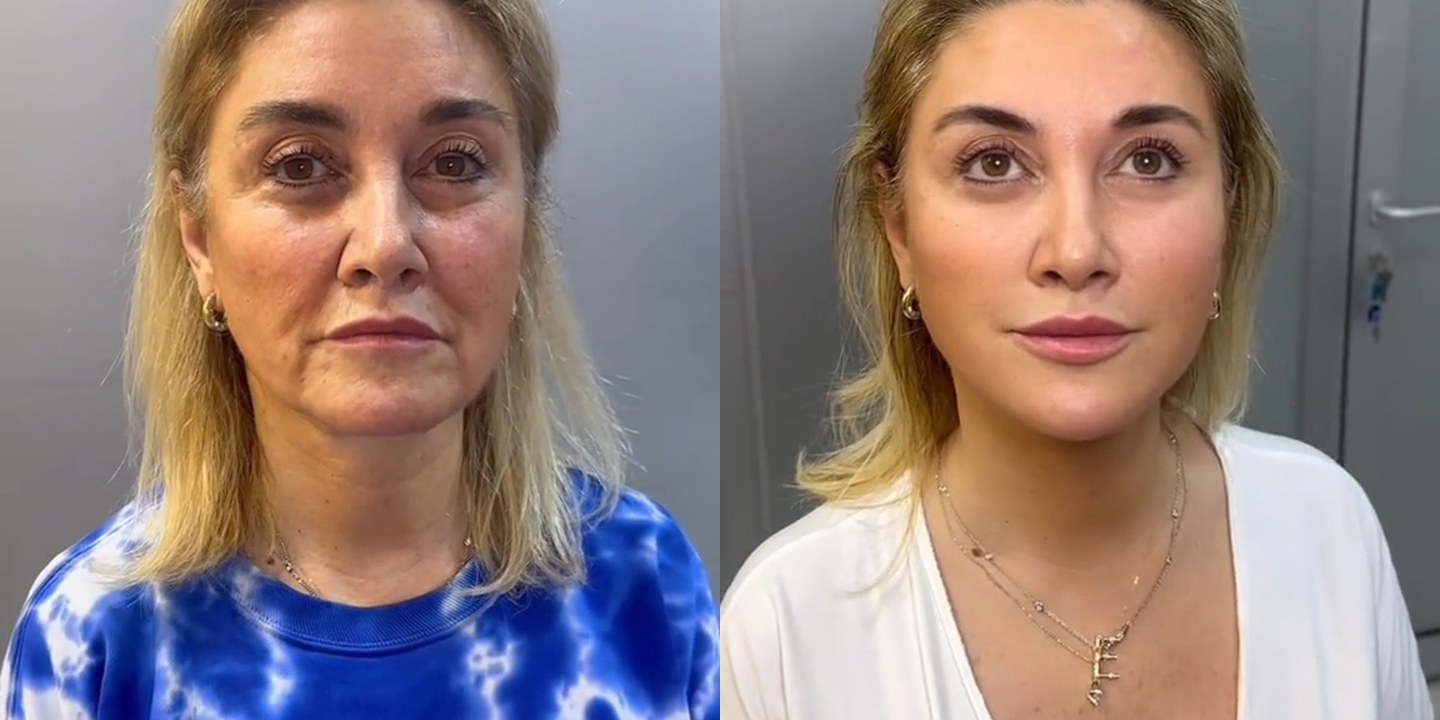Antes e depois rejuvenescimento caso 50