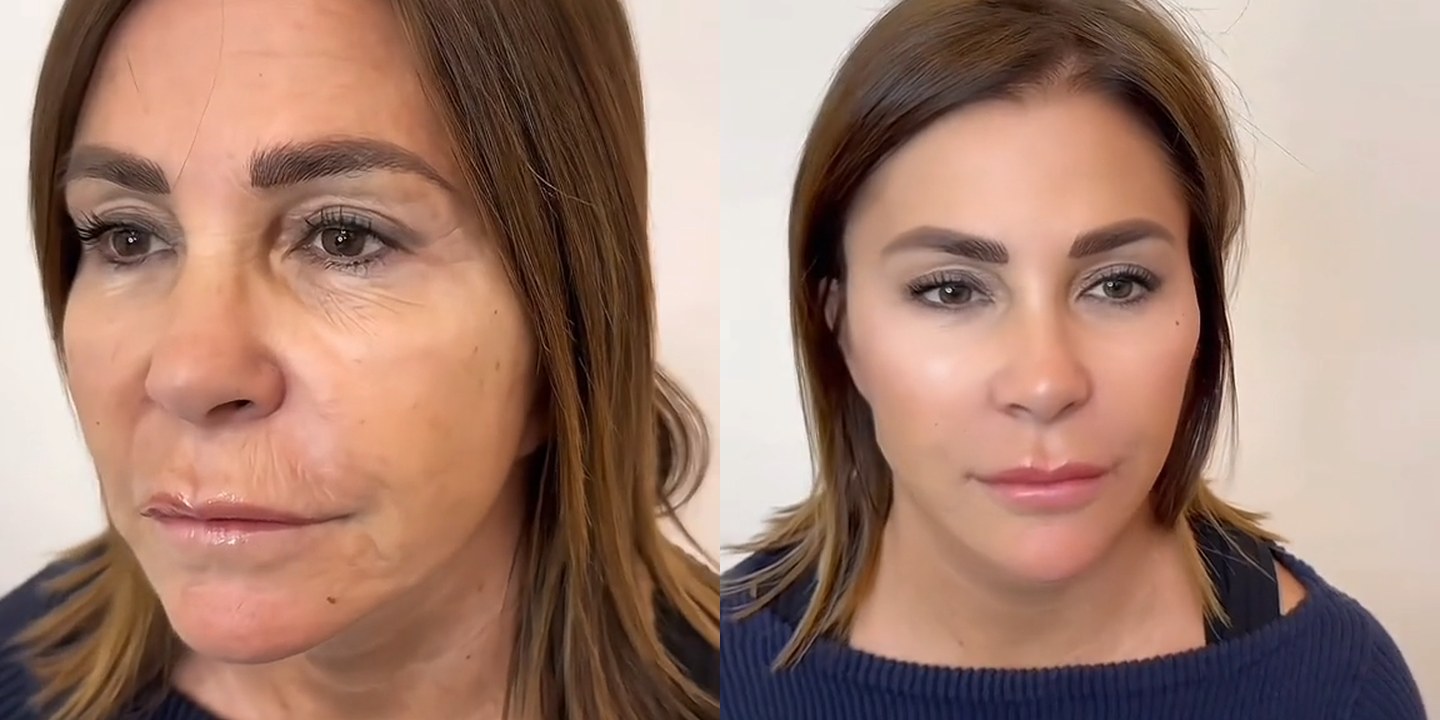 Antes e depois rejuvenescimento caso 51